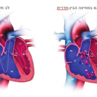 פגם במחיצה הבין-פרוזדורית (ASD)