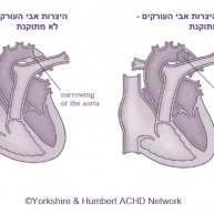 הצרות (coarctation) אבי העורקים