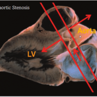 היצרות תת-אאורטלית (Sub-aortic Stenosis)