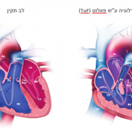 טטרלוגיה ע"ש פאלוט (Tetralogy of Fallot)