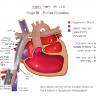 מומי חדר יחיד ופרוצדורת פונטאן (Fontan)