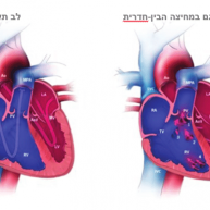 פגם במחיצה הבין-חדרית (Ventricular Septal Defect – VSD)